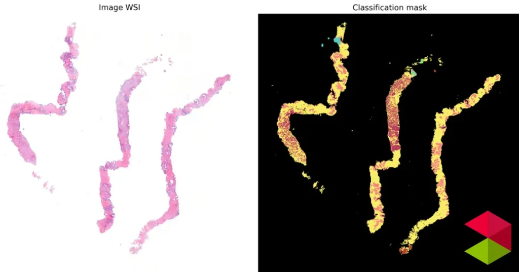 Noticias Santander El Servicio de Anatomía Patológica avanza en el primer algoritmo de IA desarrollado en Valdecilla para el cribado del cáncer de próstata